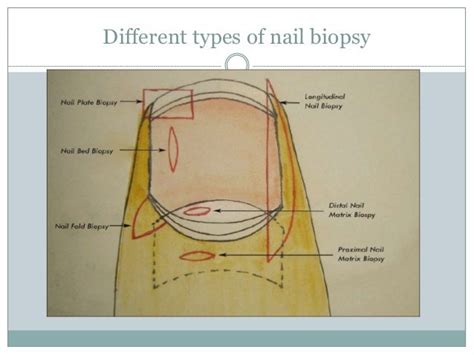 Nail biopsy