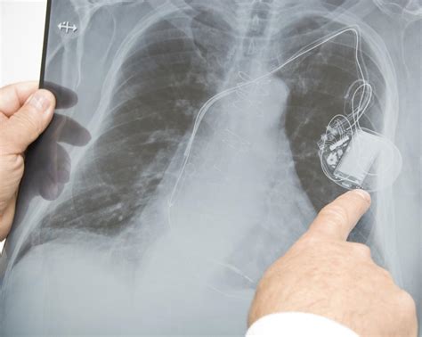 Heart pacemaker surgery: Purpose, procedure, and risks