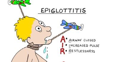 Dental Mnemonics: Epiglottitis