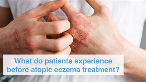 Holistic Treatment For Eczema - Eczema: A Holistic Perspective / Though the exact relationship ...