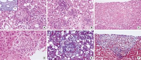 Granuloma types in liver biopsies from patients with acute Q fever ...