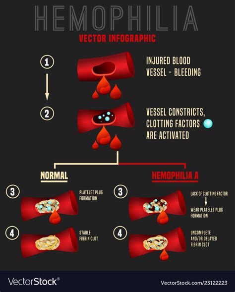 Hemophilia infographics image Royalty Free Vector Image