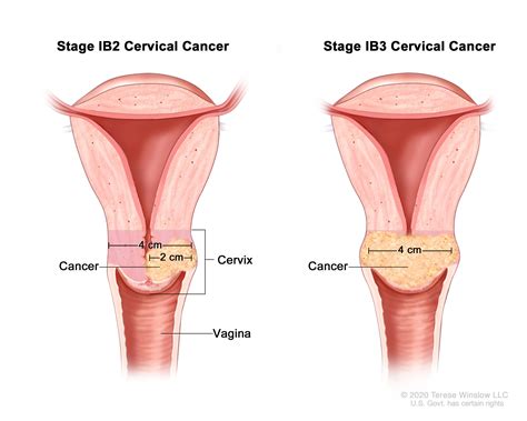 Cervix With Cancer