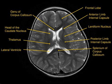 PPT - MRI of Brain/Head and Neck PowerPoint Presentation, free download - ID:601 - DaftSex HD