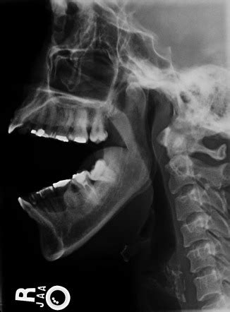 Temporomandibular joint dislocation | Radiology Reference Article ...