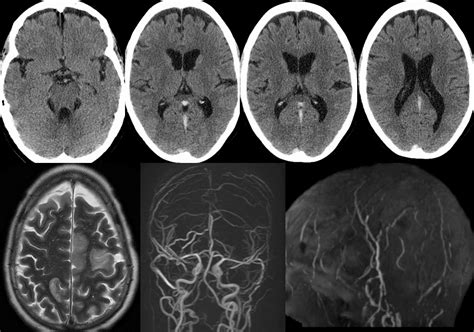 Dural Sinus Thrombosis