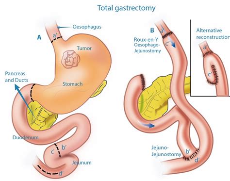 Stomach Cancer Surgery Perth | Gastrectomy | Abdominal Surgery