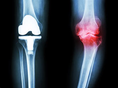 Treatment Options for Degenerative Joint Disease