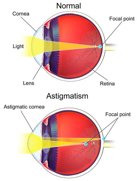 Astigmatism – Central Florida Eye Center, P.A.