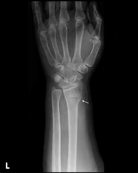 An x-ray showing left distal radius fracture of the patient (arrow). | Download Scientific Diagram