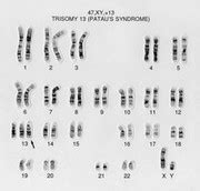 Patau's syndrome karyotype 47,XY,+13 | Wellcome Collection