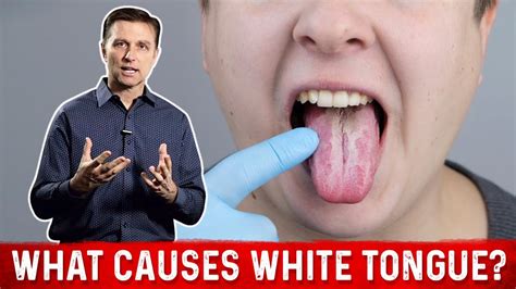 What Causes White Tongue? – Dr.Berg on Oral Candidiasis - YouTube