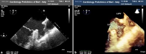 Pectinate muscles in the apex of left atrial appendage. Two-dimensional... | Download Scientific ...