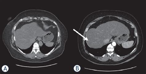 A male patient with a suspect and unclear hepatic lesion with 6 mm in... | Download Scientific ...