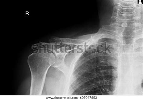 Xray Image Show Fracture Shoulder Right Stock Photo 607047653 | Shutterstock