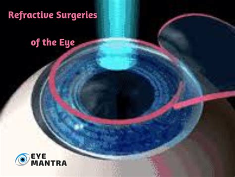 Refractive Surgery | Refractive Errors & Types of Treatment | EyeMantra