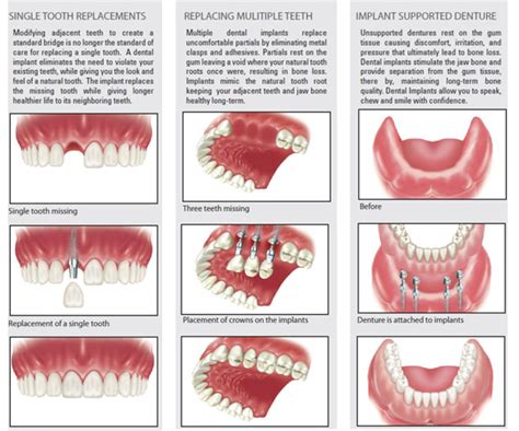 Types of Dental Implant |Dental Clinic in Madurai | Agaram Dental ...