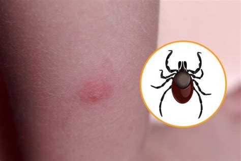 12 Bug Bites Anyone Should Be Able to Identify - Factspedia