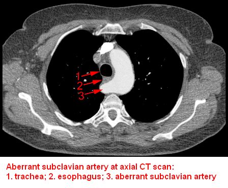 Clive Kitten's Surgery: Aberrant Subclavian Artery