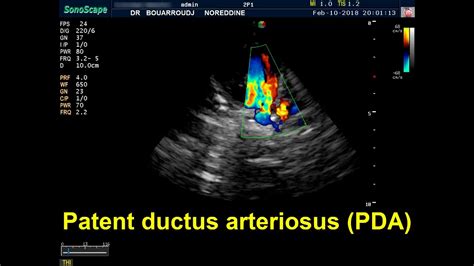 Patent ductus arteriosus PDA echocardiography - YouTube