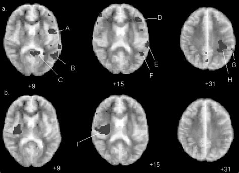 Schizophrenia Auditory Hallucinations