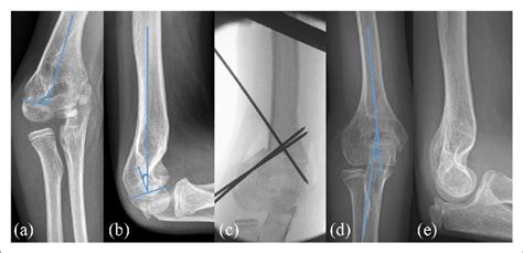 An illustrative case of a severe posttraumatic varus deformity is shown... | Download Scientific ...