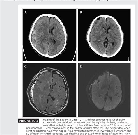 Figure 10-2 from Complications of Neurosurgery | Semantic Scholar