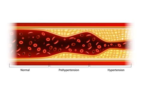 Common Causes of Atrial Fibrillation - ActiveBeat