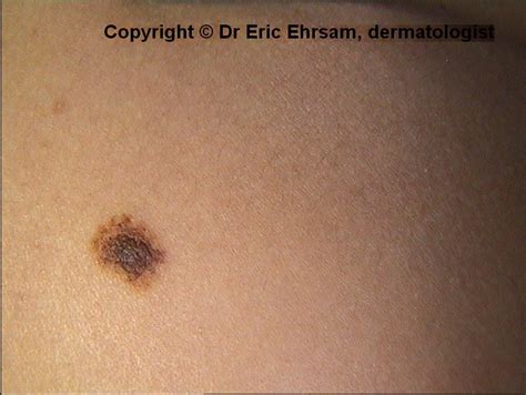 dermoscopy: Compound melanocytic nevus