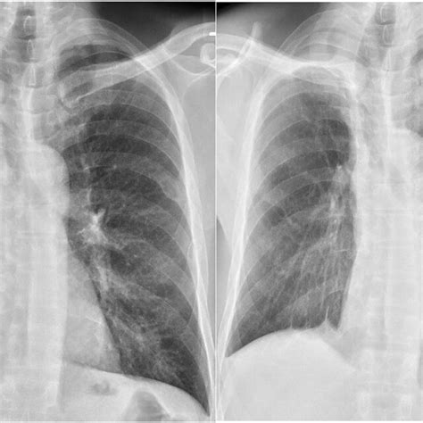 Computer Tomography of chest post right upper lobe resection. | Download Scientific Diagram