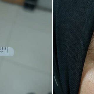 Schirmer test I at right eye of female patient that showed value of ...