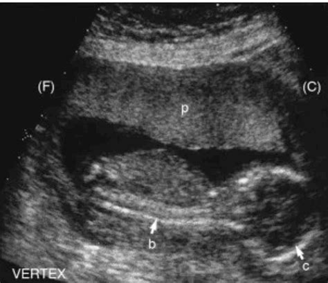 cephalic presentation radiology