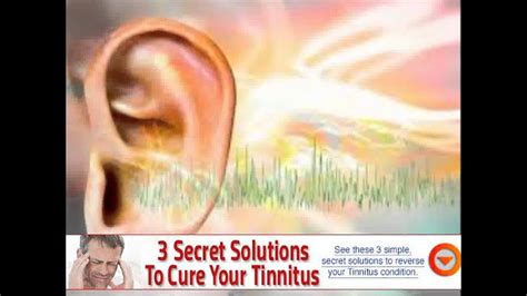 cerumen ear wax impaction treatment - YouTube