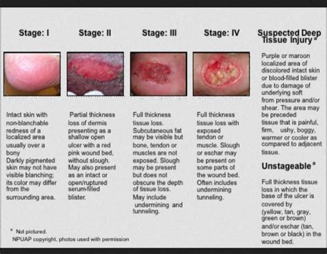 Pressure Injury Pressure Ulcer Staging Pressure Ulcer Wound Care 44160 ...