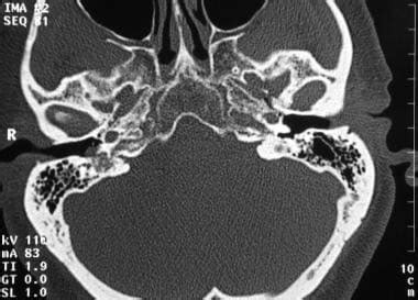 Benign Tumors of the Middle Ear: Practice Essentials, Glomus Tympanicum ...