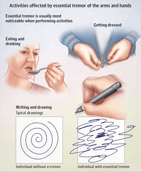 Essential Tremors - Birmingham Hand and Plastic Surgery