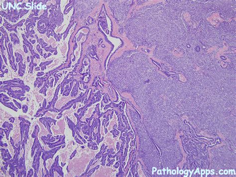 endometrial carcinosarcoma pathology