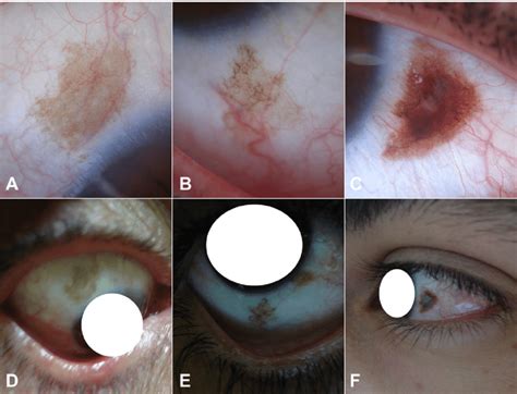 (A), (B), and (C) Dermoscopic views of some OPs (original magnification... | Download Scientific ...