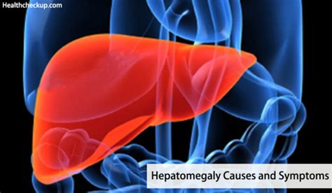 Mild, Massive, Tender Hepatomegaly Causes and Symptoms