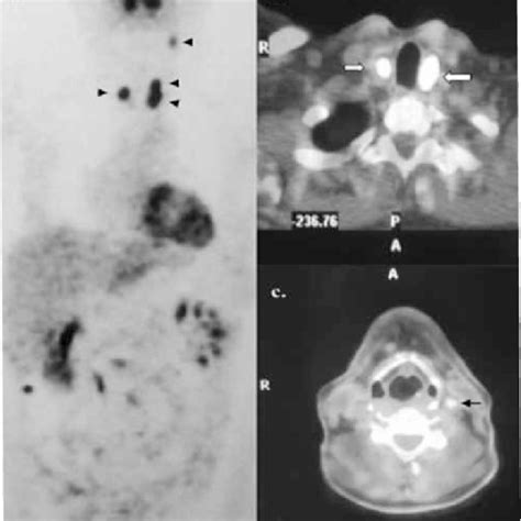 Preoperative 99m Tc-MIBI whole body scan (a) and neck pinhole image (b)... | Download Scientific ...