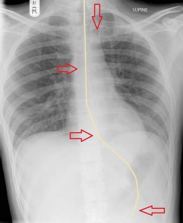 Annotated nasogastric tube placement | Radiology Case | Radiopaedia.org