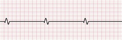 EKG Basics– How to Identify ECG Rhythms