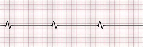 EKG Basics– How to Identify ECG Rhythms