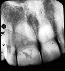 Macrodontia - Developmental Disturbances of Teeth