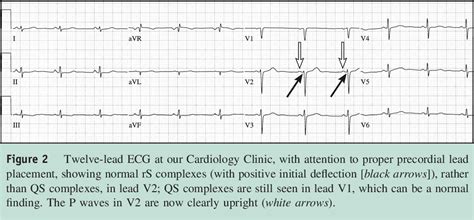 What Is The Treatment For A Septal Infarct