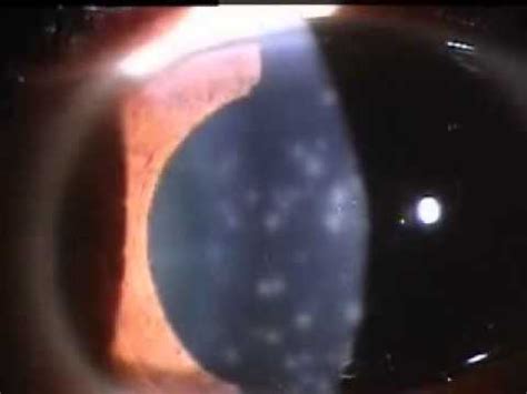 coarse punctate keratitis - YouTube