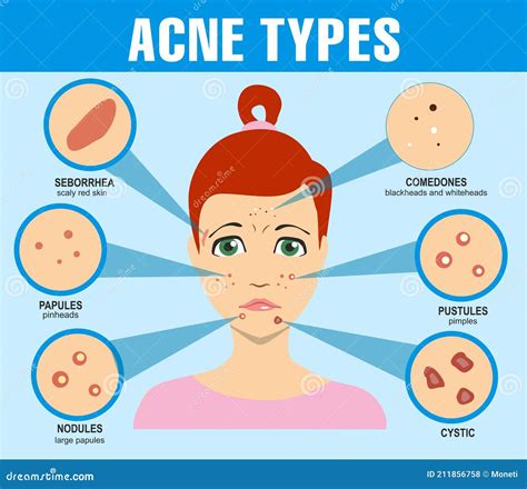 Acne Types, Skin Pimples Blackheads and Face Comedones. Infographics of Acne. Girl with Types of ...