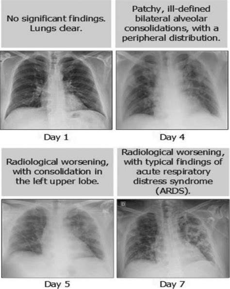 Chest X-Ray image of COVID-19 Patient [17] | Download Scientific Diagram