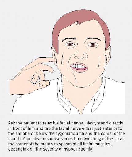 International University: Sign of hypocalcemia