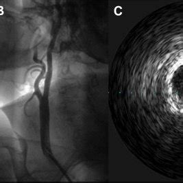 A) Proximal ICA stenosis of 80% detected angio-magnetic resonance. B ...